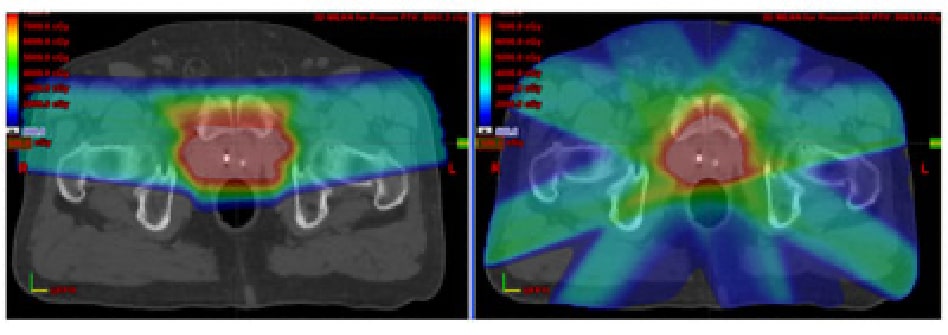 Comparsion of Proton Therapy (left) versus IMRT (right)
