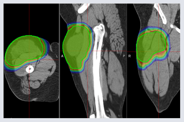 Bone Thigh Cancer Scan