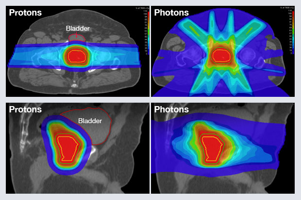 Comparison of proton therapy (top) versus IMRT (bottom)