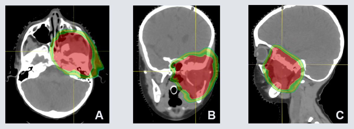 SARCOMA EWING IMAGES