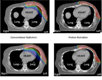 Radiation dose distribution for treatment of the left chest wall and regional lymph nodes after mastectomy. Treatment with conventional radiation is on the left and treatment with proton radiation is on the right.