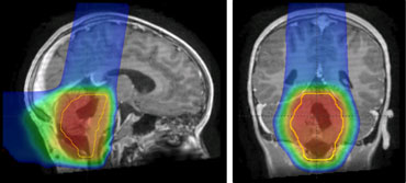 Proton therapy for a childhood ependymoma