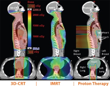 Radiation exposure comparison for 3D-CRT (left) versus IMRT (center) versus Proton Therapy (right)