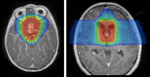 Proton therapy for a low grade glioma