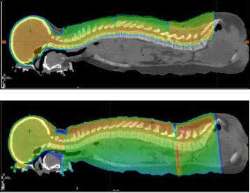 Side view of a medulloblastoma patient undergoing proton craniospinal irradiation (CSI) (top) and X-ray craniospinal radiation (CSI) (bottom).