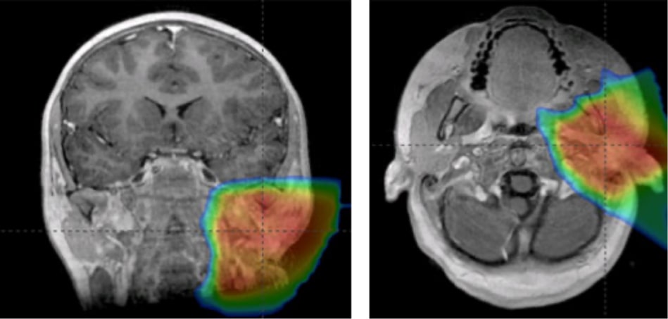 Proton therapy for a parotid carcinoma