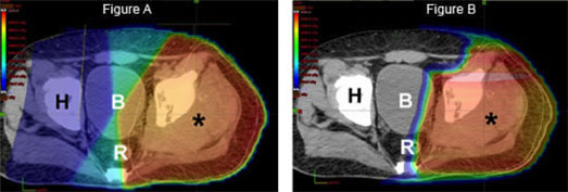 Dose distribution comparison between a conventional radiation plan (Figure A) and a proton therapy plan (Figure B) in a young patient with a pelvic sarcoma