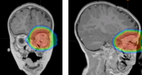 Retinoblastoma Treatment - NCI