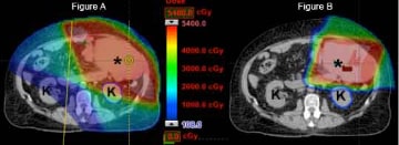 Dose distribution comparison between a conventional radiation plan (Figure A) and a proton therapy plan (Figure B) in a patient with an abdominal sarcoma (*). Note the difference in dose to the kidneys (K).