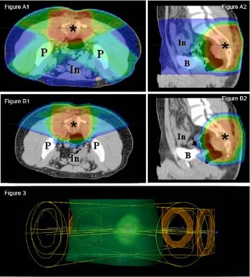 Dose distribution comparison between a conventional radiation plan (Figure A) and a proton therapy plan (Figure B) in a patient with an abdominal sarcoma