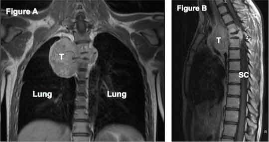 sarcoma cancer in lungs